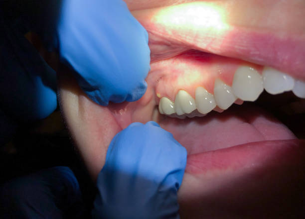 Best Emergency Care for Gum Disease in Metamora, IL