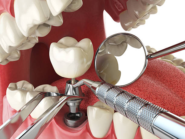 Best Emergency Cosmetic Dentistry (e.g., broken veneers) in Metamora, IL